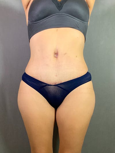Standard Abdominoplasty Before & After Gallery - Patient 193668020 - Image 2
