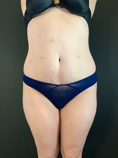 Standard Abdominoplasty Before & After Gallery - Patient 403028 - Image 1