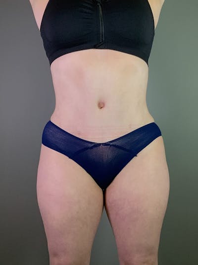 Standard Abdominoplasty Before & After Gallery - Patient 403028 - Image 2