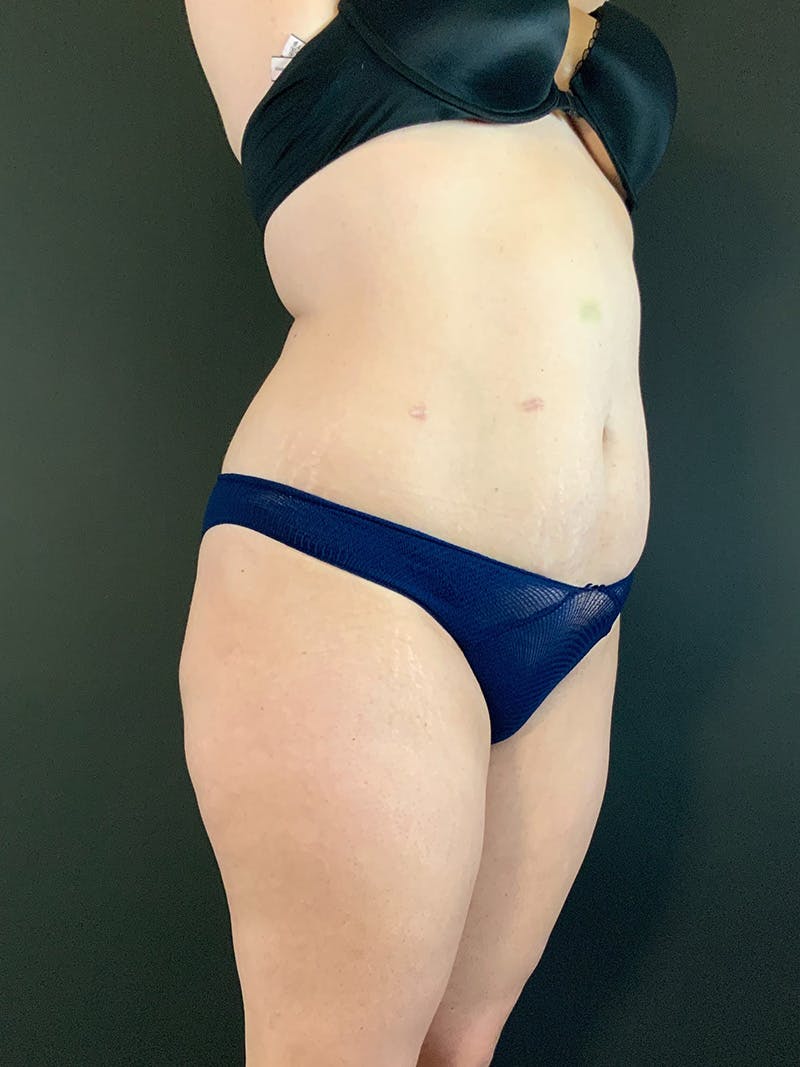 Standard Abdominoplasty Before & After Gallery - Patient 403028 - Image 3