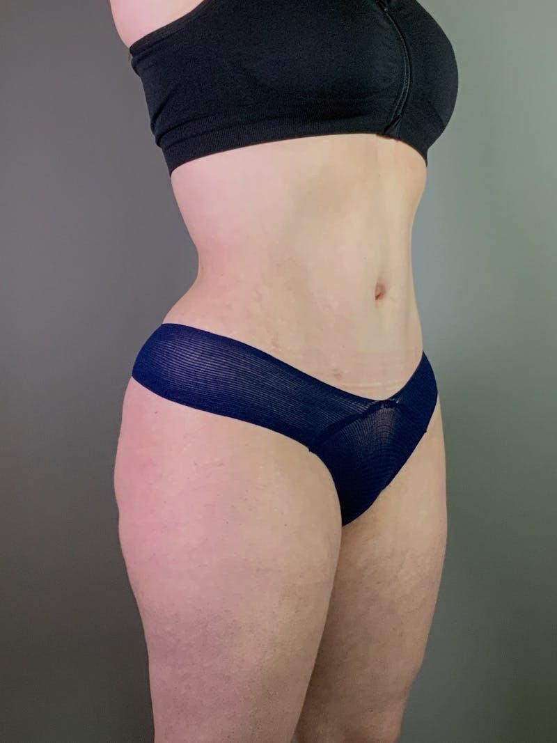 Standard Abdominoplasty Before & After Gallery - Patient 403028 - Image 4