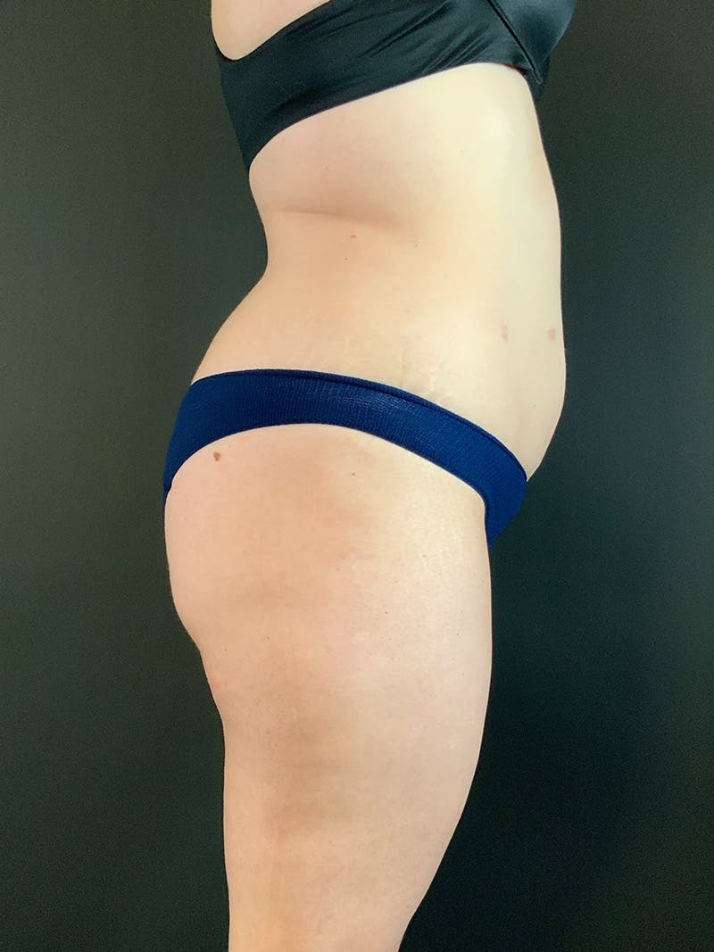 Standard Abdominoplasty Before & After Gallery - Patient 403028 - Image 5