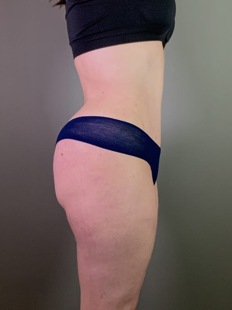 Standard Abdominoplasty Before & After Gallery - Patient 403028 - Image 6