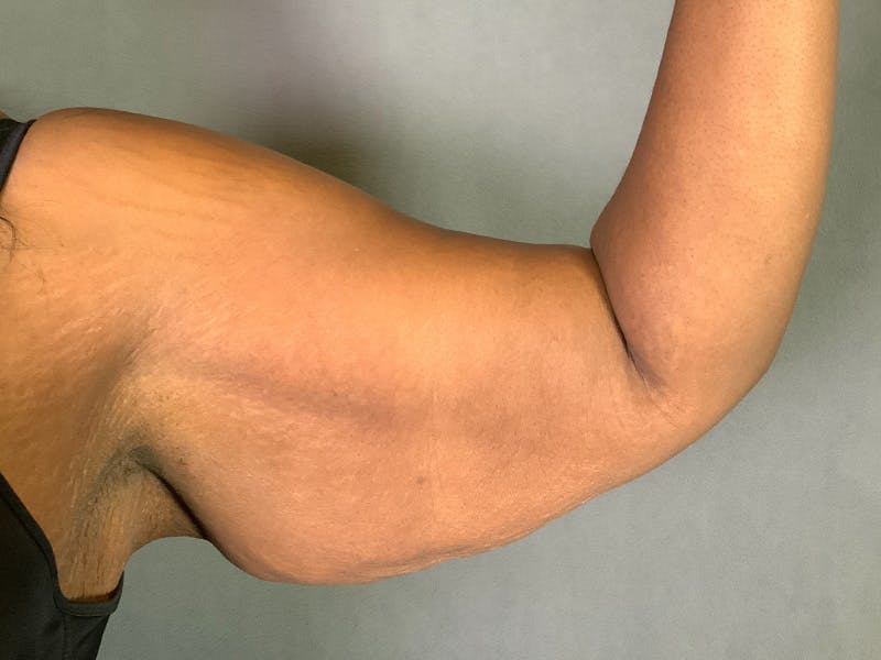 Arm Lift (Brachioplasty) Before & After Gallery - Patient 136661 - Image 3