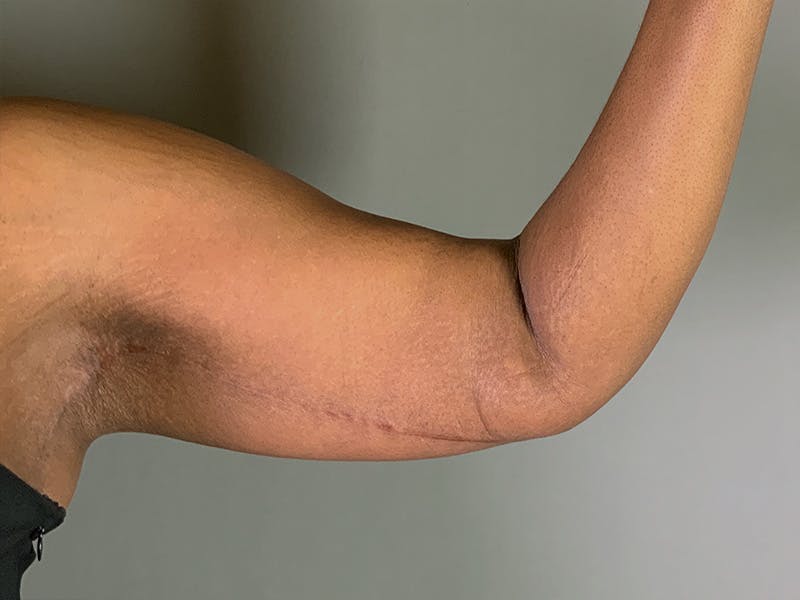 Arm Lift (Brachioplasty) Before & After Gallery - Patient 136661 - Image 4