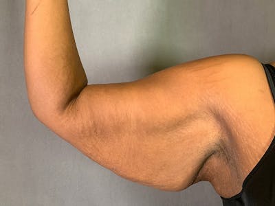 Arm Lift (Brachioplasty) Before & After Gallery - Patient 136661 - Image 1