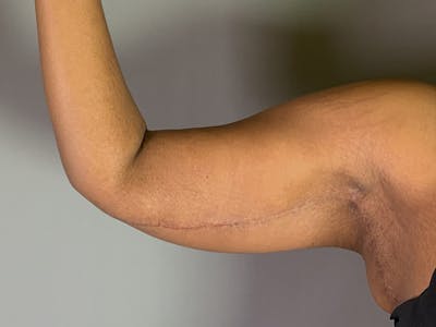 Arm Lift (Brachioplasty) Before & After Gallery - Patient 136661 - Image 2