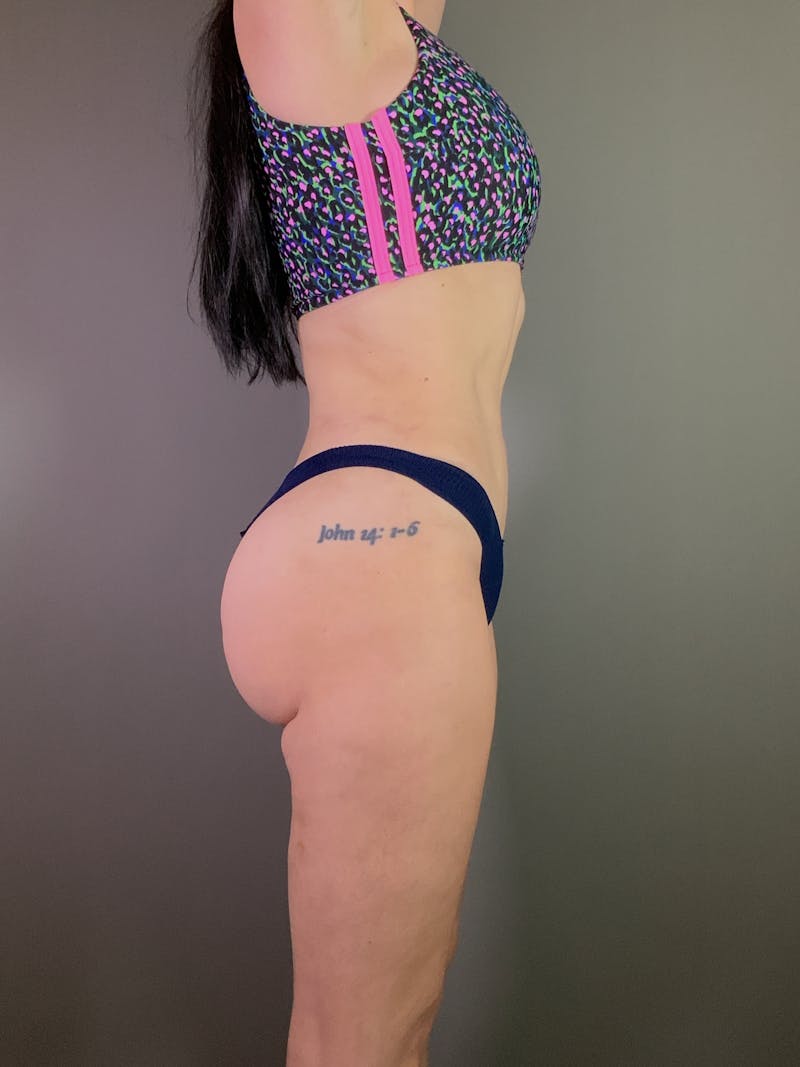 Liposuction Before & After Gallery - Patient 423261 - Image 6