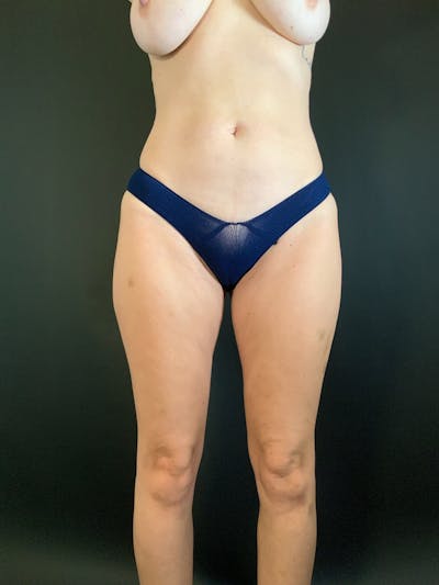 Liposuction Before & After Gallery - Patient 423261 - Image 1