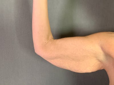 Arm Lift (Brachioplasty) Before & After Gallery - Patient 455140 - Image 1