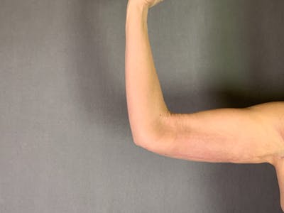 Arm Lift (Brachioplasty) Before & After Gallery - Patient 455140 - Image 2