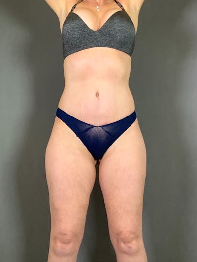 Standard Abdominoplasty Before & After Gallery - Patient 267767 - Image 2