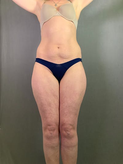 Standard Abdominoplasty Before & After Gallery - Patient 267767 - Image 1