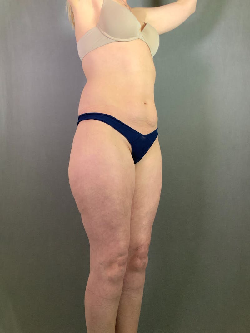 Standard Abdominoplasty Before & After Gallery - Patient 267767 - Image 3