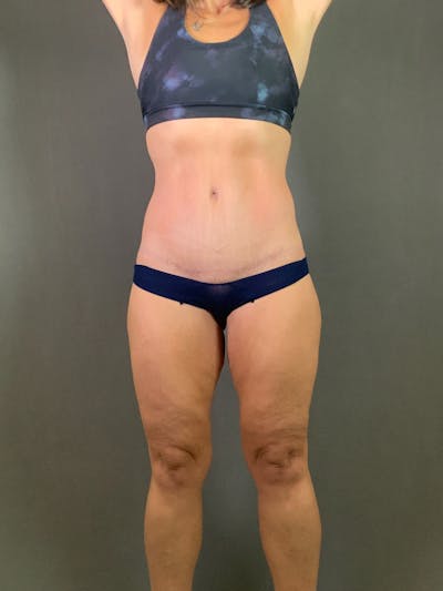 Extended Tummy Tuck  Before & After Gallery - Patient 625041 - Image 2