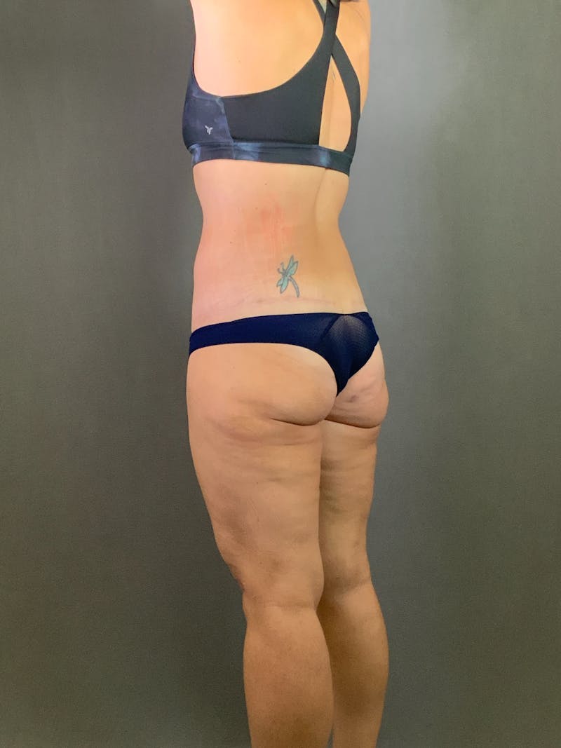 Extended Tummy Tuck  Before & After Gallery - Patient 625041 - Image 6