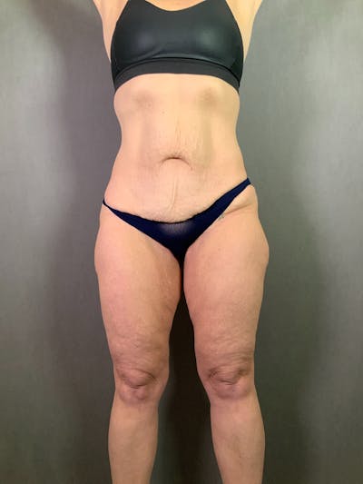 Extended Tummy Tuck  Before & After Gallery - Patient 625041 - Image 1