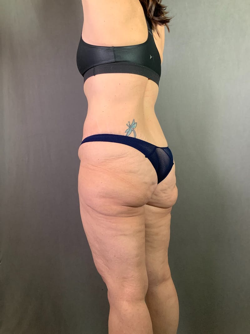 Extended Tummy Tuck  Before & After Gallery - Patient 625041 - Image 5