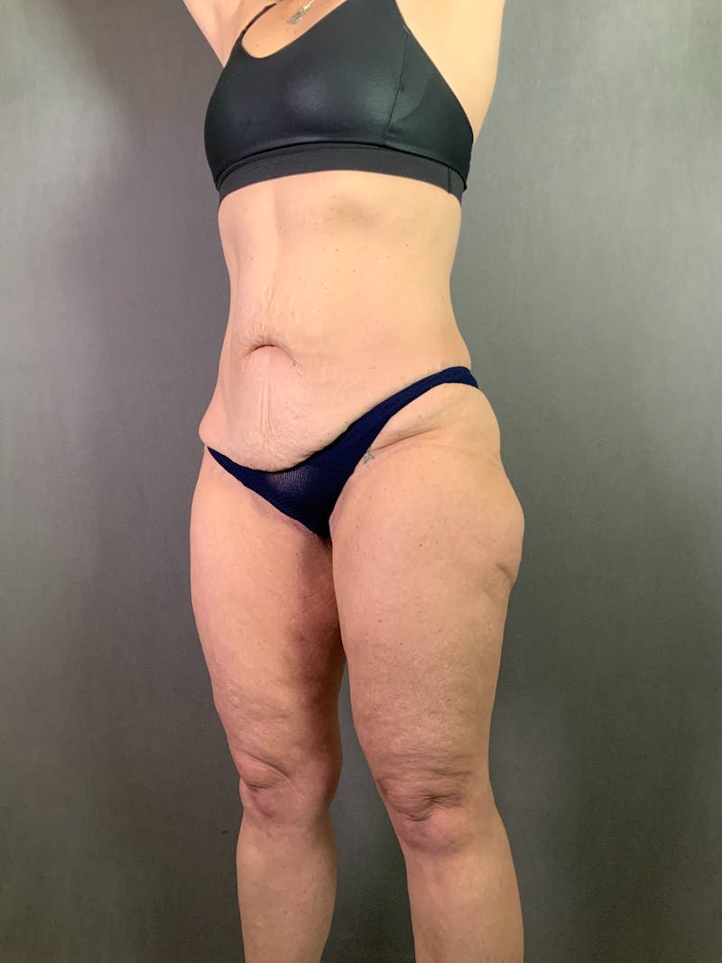 Extended Tummy Tuck  Before & After Gallery - Patient 625041 - Image 3
