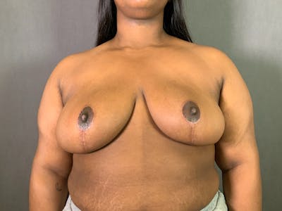 Breast Reduction Before & After Gallery - Patient 427987 - Image 2