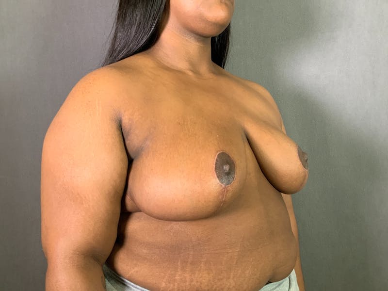 Breast Reduction Before & After Gallery - Patient 427987 - Image 6