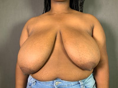 Breast Reduction Before & After Gallery - Patient 427987 - Image 1