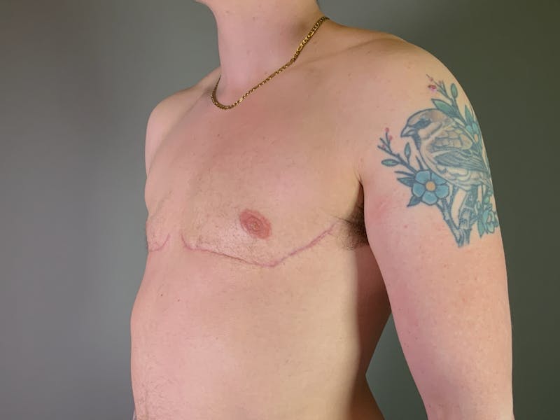 Top Surgery (Female to Male) Before & After Gallery - Patient 530462 - Image 6