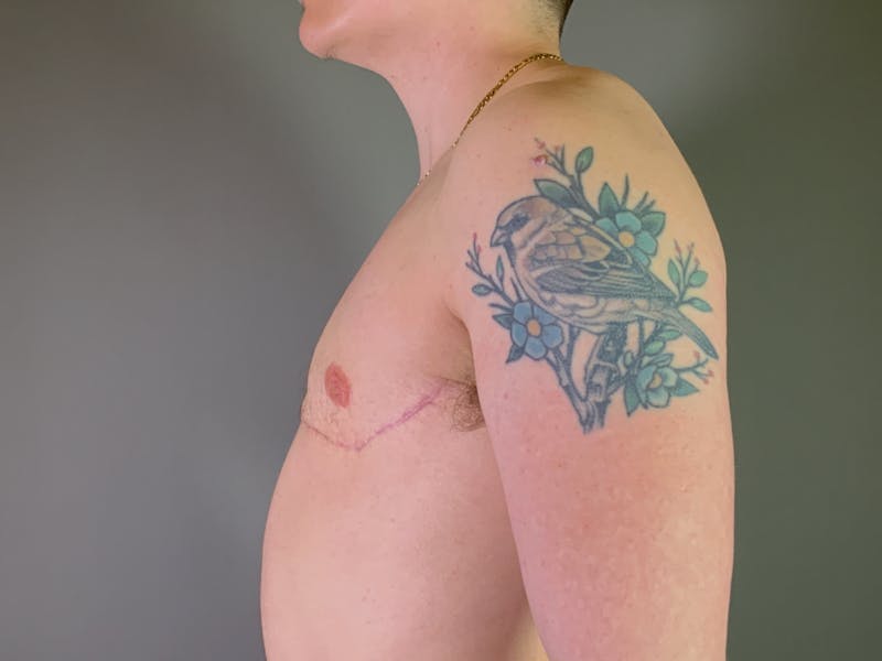 Top Surgery (Female to Male) Before & After Gallery - Patient 530462 - Image 4