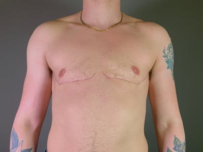 Top Surgery (Female to Male) Before & After Gallery - Patient 530462 - Image 2