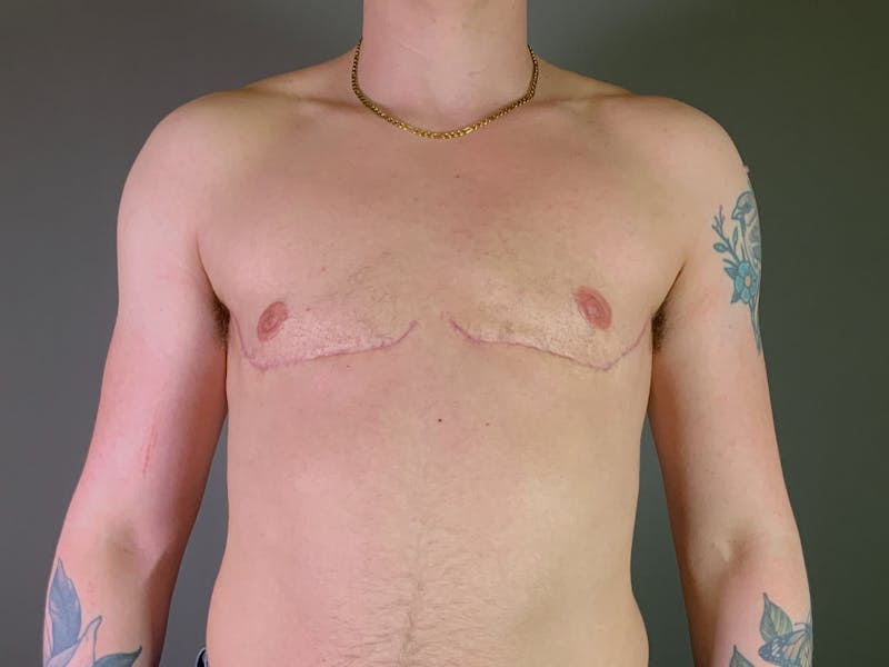 Top Surgery (Female to Male) Before & After Gallery - Patient 530462 - Image 2