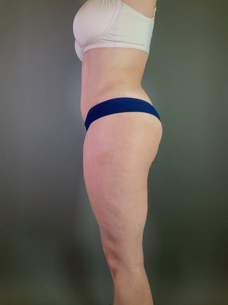 Body Lift Before & After Gallery - Patient 408232 - Image 4