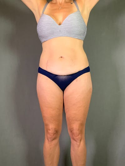 Body Lift Before & After Gallery - Patient 408232 - Image 1