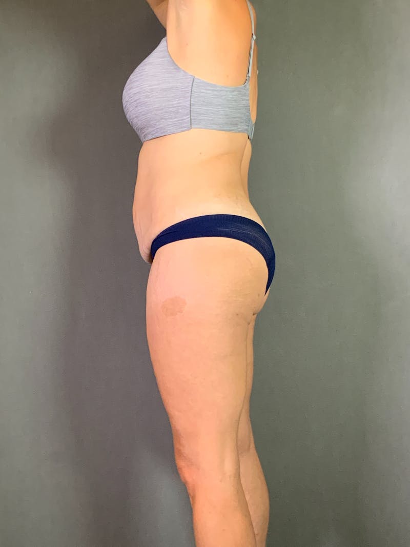 Body Lift Before & After Gallery - Patient 408232 - Image 3