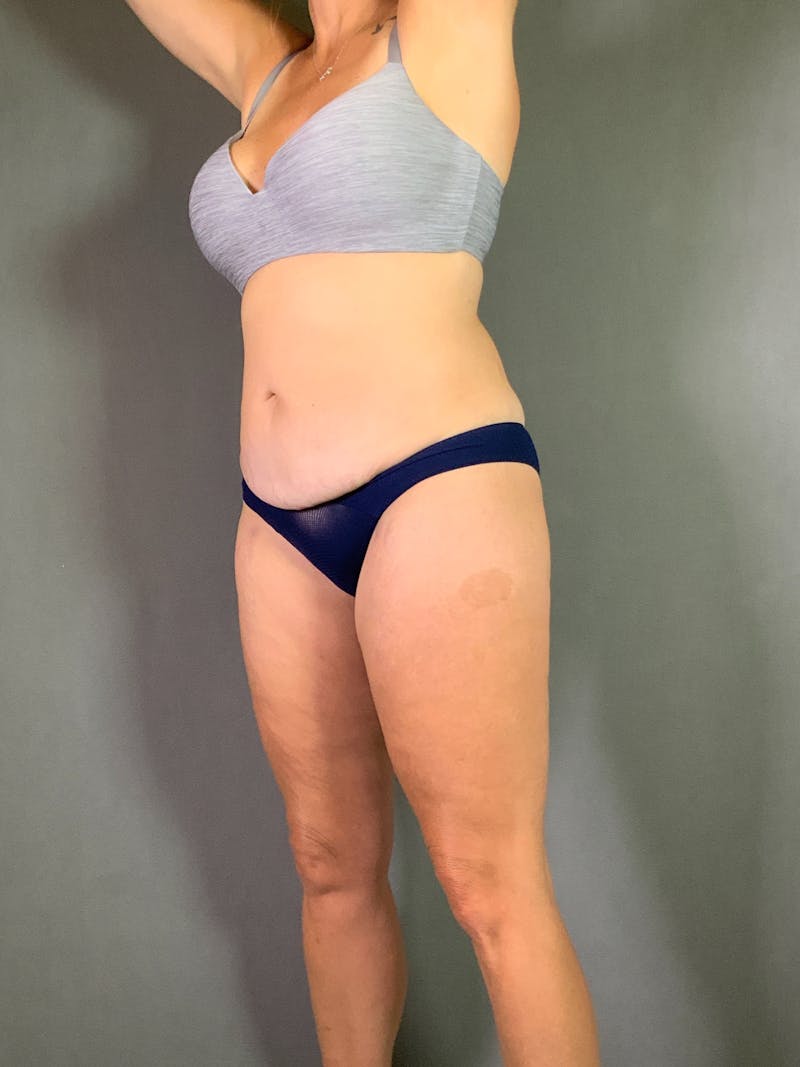 Body Lift Before & After Gallery - Patient 408232 - Image 5