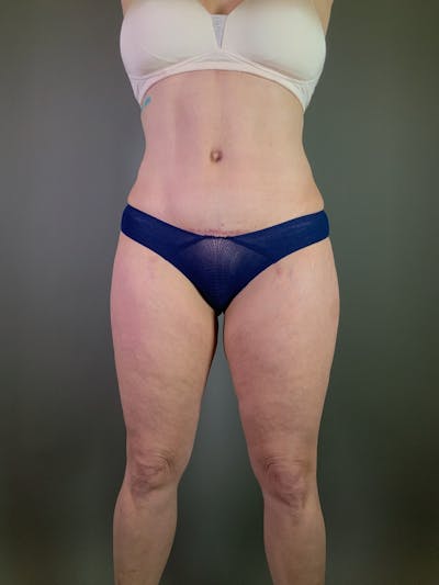 Body Lift Before & After Gallery - Patient 408232 - Image 2