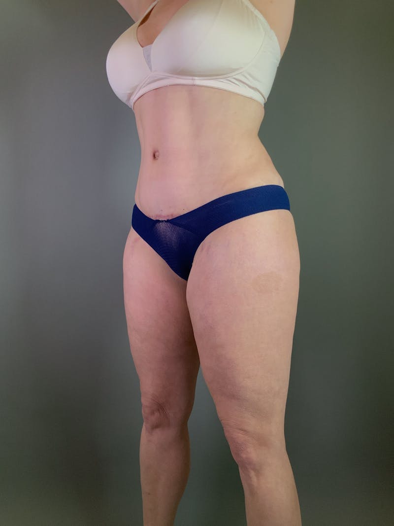 Body Lift Before & After Gallery - Patient 408232 - Image 6