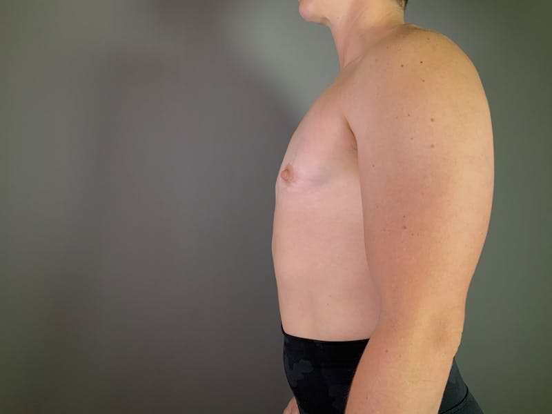 Top Surgery (Female to Male) Before & After Gallery - Patient 244999 - Image 6