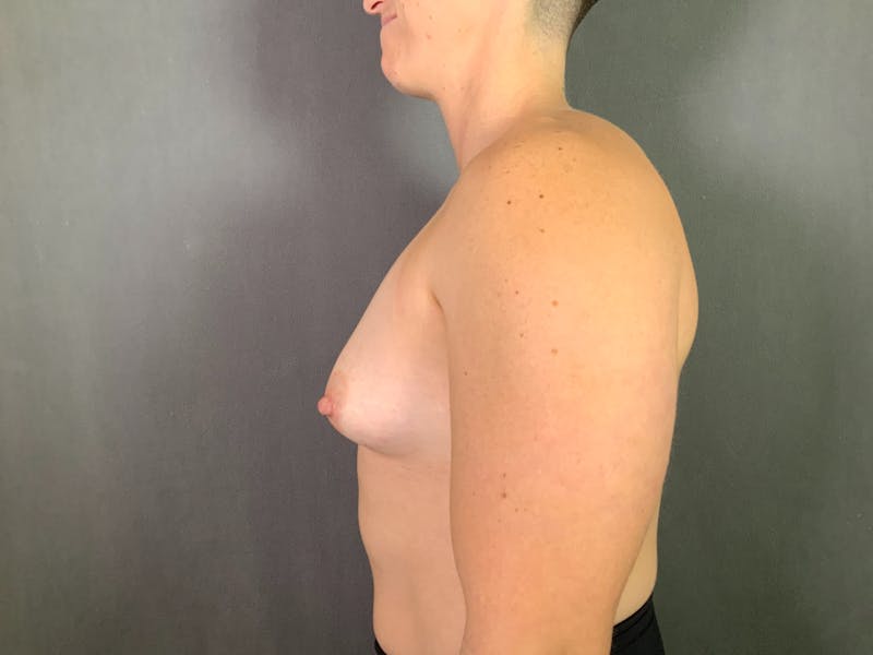 Top Surgery (Female to Male) Before & After Gallery - Patient 244999 - Image 5