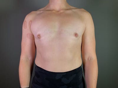 Top Surgery (Female to Male) Before & After Gallery - Patient 244999 - Image 2