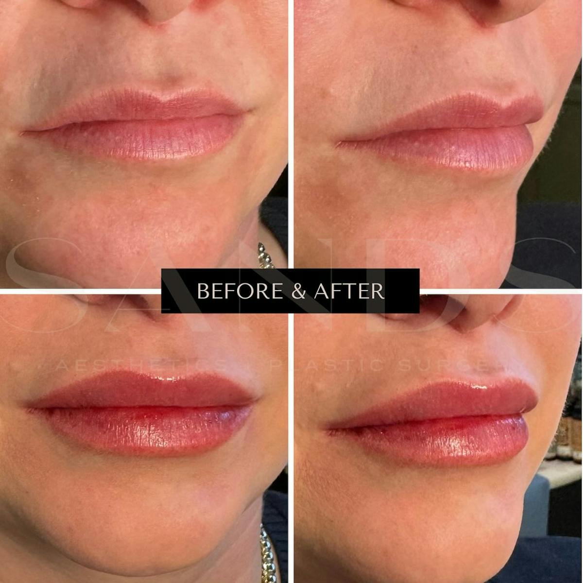 Lip Filler Before & After Gallery - Patient 296739 - Image 1