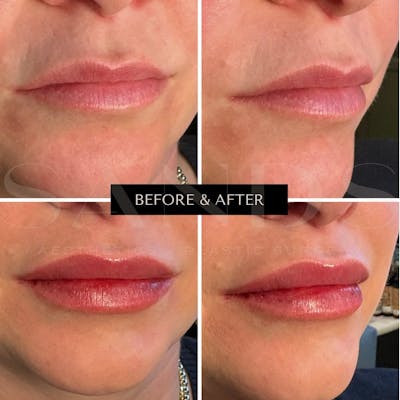 Lip Filler Before & After Gallery - Patient 296739 - Image 1