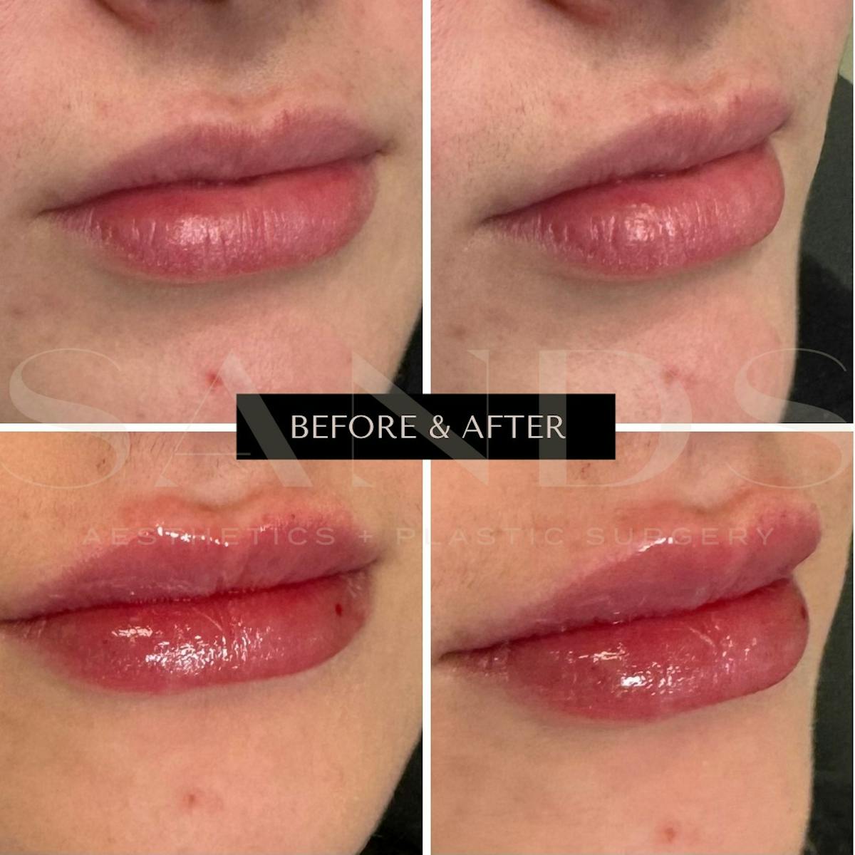 Lip Filler Before & After Gallery - Patient 207548 - Image 1