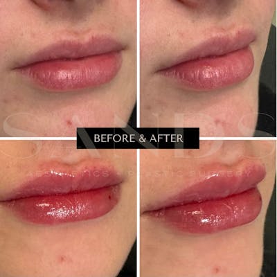 Lip Filler Before & After Gallery - Patient 207548 - Image 1