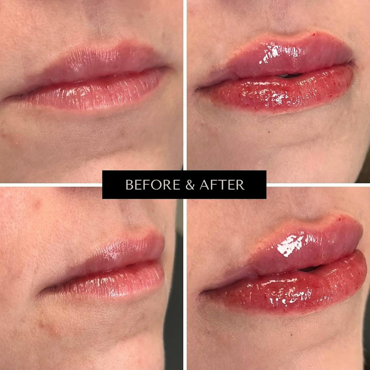 Lip Filler Before & After Gallery - Patient 106806 - Image 1