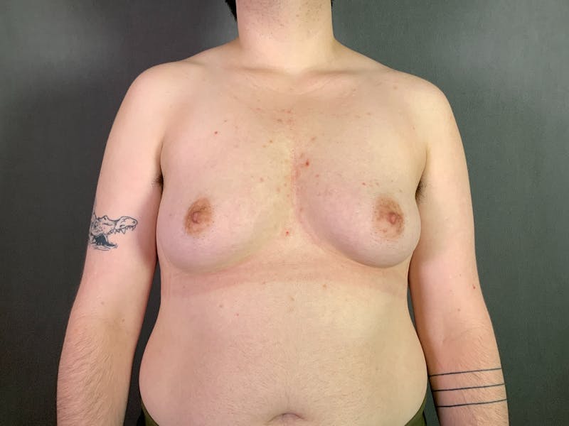 Top Surgery (Female to Male) Before & After Gallery - Patient 361883 - Image 1