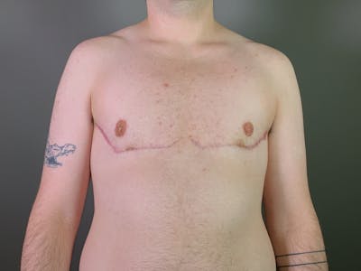 Top Surgery (Female to Male) Before & After Gallery - Patient 361883 - Image 2