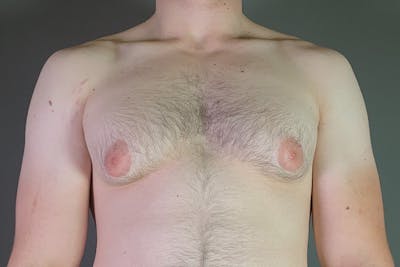 Gynecomastia Before & After Gallery - Patient 337526 - Image 1