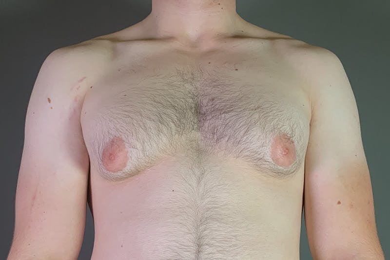 Gynecomastia Before & After Gallery - Patient 337526 - Image 1
