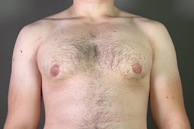 Gynecomastia Before & After Gallery - Patient 337526 - Image 2