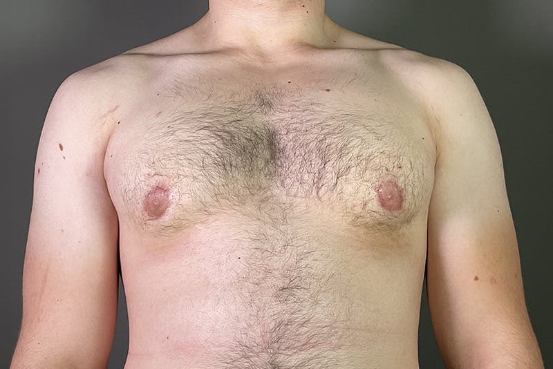 Gynecomastia Before & After Gallery - Patient 337526 - Image 2